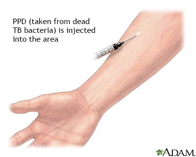 tb test results images|Purified Protein Derivative (PPD) Skin Test for .